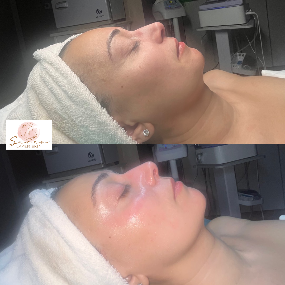Before and after facial treatment result 1
