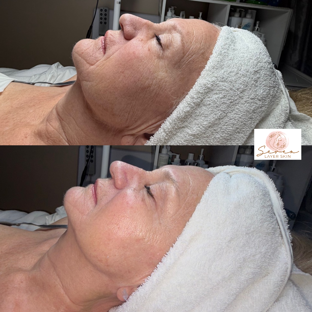 Before and after facial treatment result 3