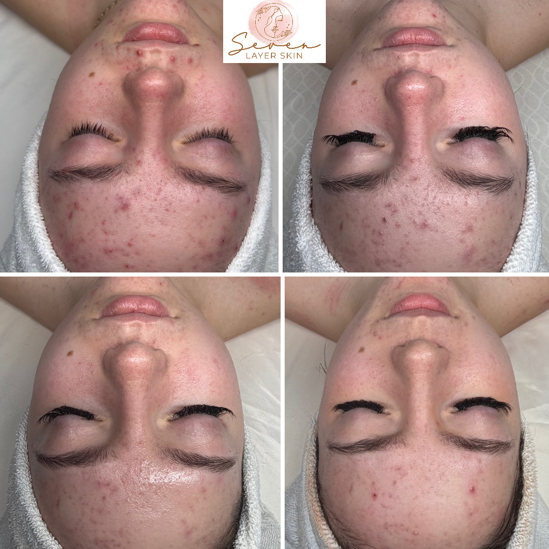 Before and after facial treatment result 4