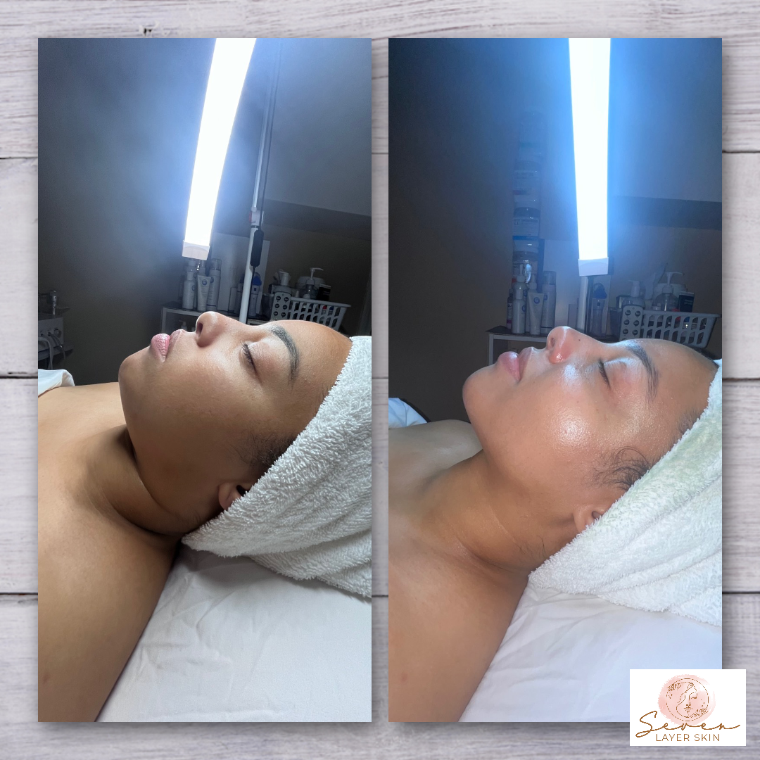 Before and after facial treatment result 9
